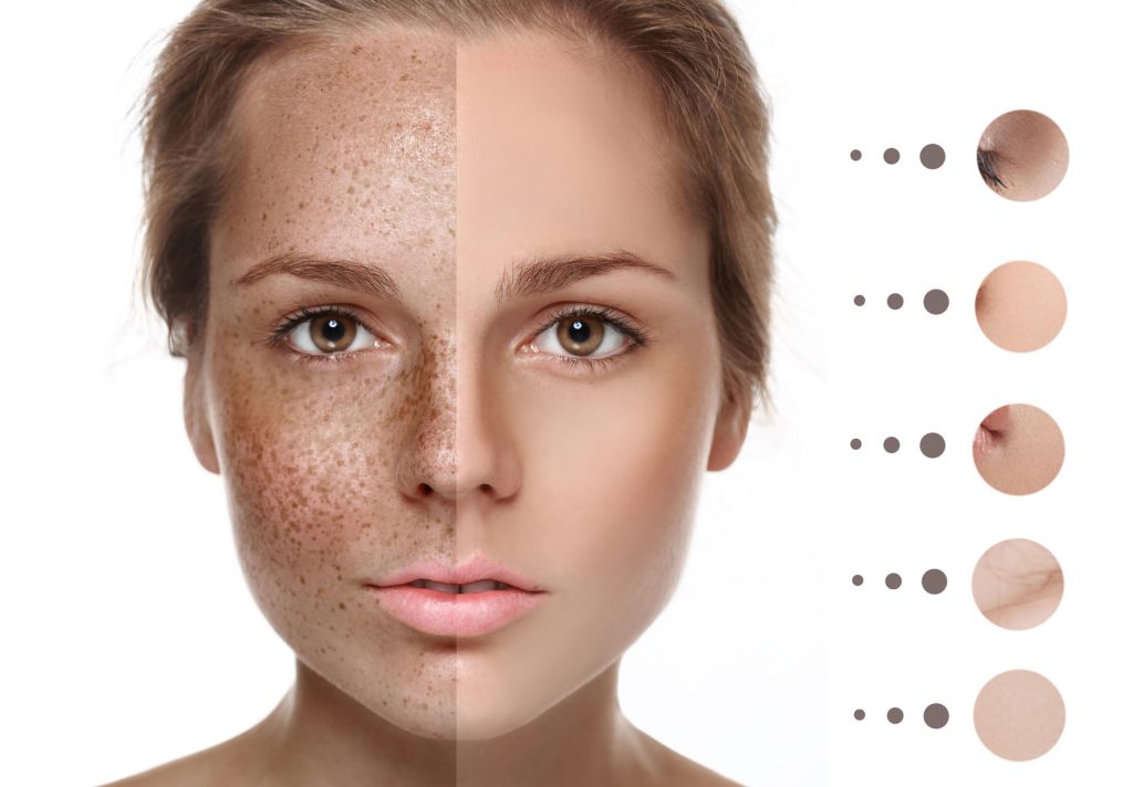 Tretinoin and Dark Spots: Does Tretinoin Help with Dark Spots